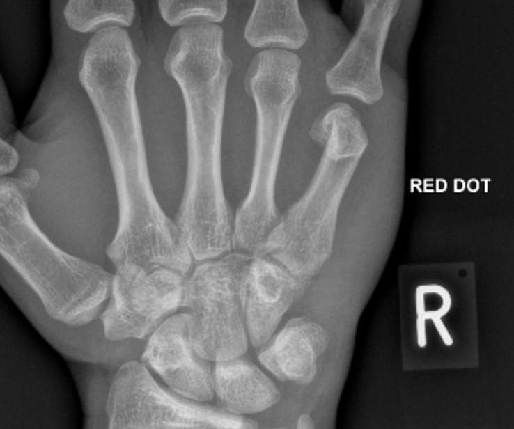 hand x ray